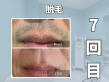 エックス(X)/【メンズ脱毛】効果◎髭脱毛！