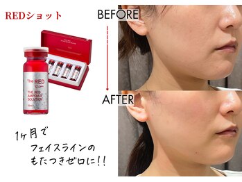 キレイベース 銀座店(KIREI BASE)/レッドショット 1ヶ月後の変化