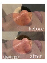 アムールドゥ 麻布十番(Amour deux)/毛穴洗浄