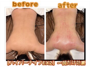 ドクタースタイル(Dr.style)の写真/ 最新型上位機種ハイパーナイフEX2認定店☆皮下脂肪層にアプローチし/内臓脂肪まで分解/サイズダウン実感