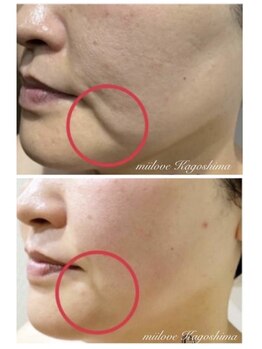 ミーラブ 鹿児島(miilove)/ほうれい線ゴルゴライン引き締め