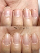 マリーロール 淀屋橋本店(Marie Laure)/自爪育成/深爪矯正/ネイルケア