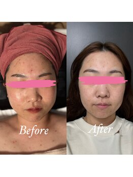 ホルバール 佐賀店(Hallbar)/ハーブピーリング