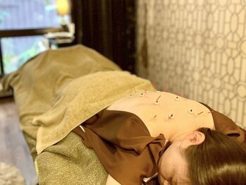 リラ鍼灸接骨院(Rela鍼灸接骨院)/美容しんきゅう