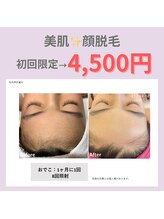 ルナ(Runa)/美肌顔脱毛の効果