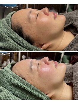 オルオル(Olu'olu)/【韓国肌管理】ララピール