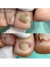 巻き爪補正店 越谷店/変形爪補正