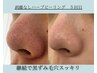 夏の肌荒れ実は皮脂が原因かも！皮脂の分泌を抑え、ニキビ・黒ずみ毛穴ケア