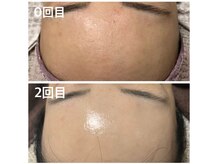 ケーナインエッセ(K9 esse)/カーボキシー炭酸パック