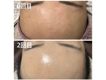 ケーナインエッセ(K9 esse)/カーボキシー炭酸パック