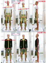 姫路なごみ整体院 なごみ鍼灸院/改善例（お尻の酷い痛み）