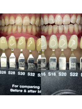 トウキョースワーズ 渋谷店(TOKYO SWRS)/#ホワイトニング #渋谷 #池袋
