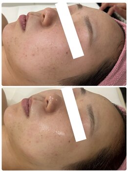 エステティックレイビス 名古屋店(RAYVIS)/アクネ菌の殺菌!