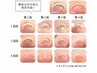 【care】　ジェルで改善！巻き爪ケア（親指2本）￥6,500