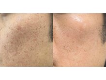 ディオーネ 岡崎店(Dione)/《韓国式ハーブピーリング》