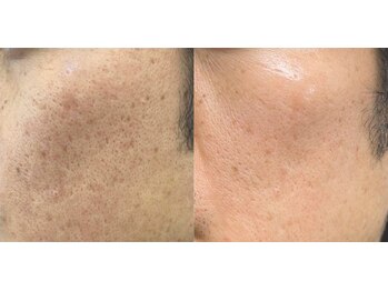 ディオーネ 岡崎店(Dione)/《韓国式ハーブピーリング》