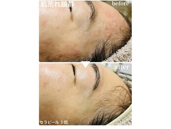 ムク(MUKU 無垢)/セラピール・肌荒れも沈静化