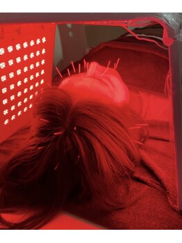 ウィル(will)/New美容鍼!オーロラセラピー