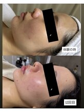 モアナ(Moana)/脂肪燃焼剤導入×小顔コルギ