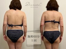ディアメデル(Diamedel)/お手入れ写真