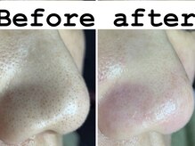 リンカ(Rinca)/毛穴が変わればお肌も変わる！