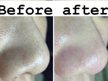 リンカ(Rinca)/毛穴が変わればお肌も変わる！