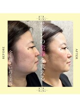 アーフ(ARF)/エクソリフト