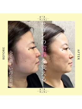 アーフ(ARF)/エクソリフト