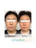 【ほうれい線改善】 小顔矯正+ラジオ波+美容整体 集中改善コースお試し 90分