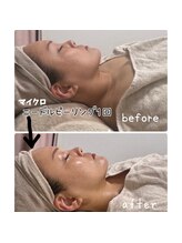 ラ ヴォーテ(La beaute)/マイクロニードルピーリング