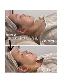 ラ ヴォーテ(La beaute)/マイクロニードルピーリング