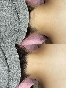 パリスヒロトン(PARIS HIROTON)/美肌脱毛【エステレベル最上級】