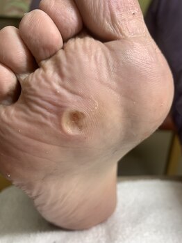 ランカ(RUNKA)/魚の目のケア