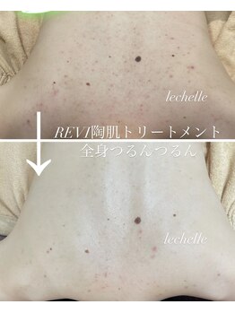 レシェルサロン(Lechelle Salon)/背中ハーブピーリング