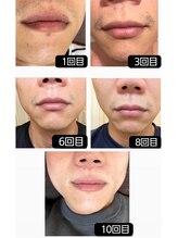 エミナル(EMINARU)/髭脱毛