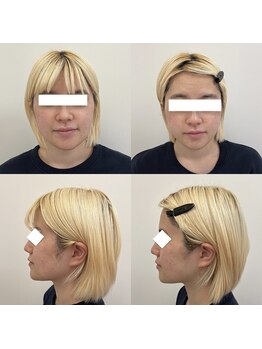 ホロニック ベルサンテ(Holonic Belle Sante)/小顔/リフトアップ