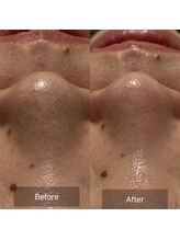 マヴィ(Mavie)/韓国式3D毛穴洗浄