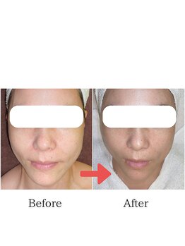 グラシア(gracia)/シミ・毛穴ケア専門店gracia