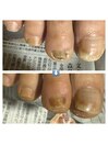 肥厚爪(変形爪)ケア