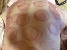 そーにゃ/カッピング