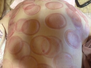 そーにゃ/カッピング