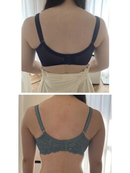 サロン ド チョコ(SALON DU CHOCO)/バストアップ症例