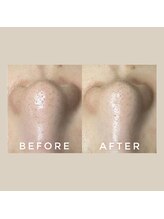 カウニス るる(kaunis)/【ララピール】Before After