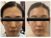 アロラヴィ(AroRavi)/サーマトリックスでたるみケア