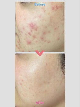 アロハーブ/ハーブピーリング