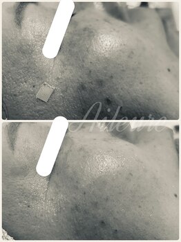 エルール トータルビューティ(Aileure total beauty)/肌のトーン シミケア