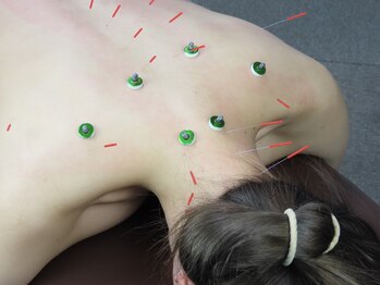 馬場3丁目整骨院/美容鍼+頭首肩トータル鍼