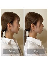 ハリベアー(HariBear)/美容鍼(1回目前後)