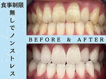 ホワイトニングショップ 八王子店/ホワイトニングビフォーアフター