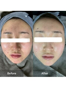 モカ 天王寺店(MOKA)/剥離ハーブピーリングニキビケア